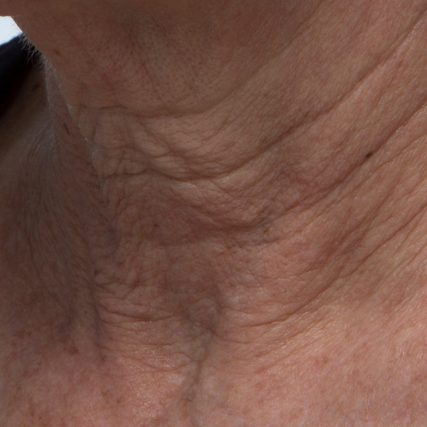 Before Resurfacing Enzyme Polish