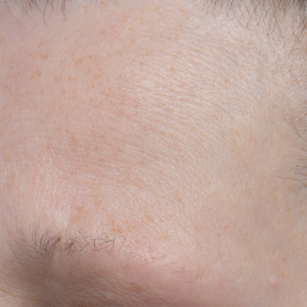 Before Resurfacing Enzyme Polish